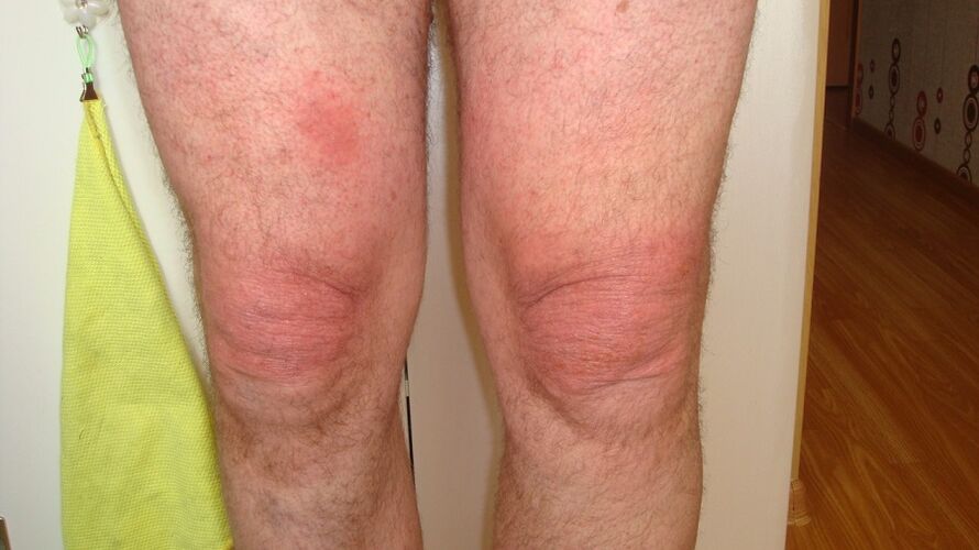 artrose das articulações do joelho