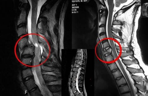 Compressão da medula espinhal - indicação para cirurgia